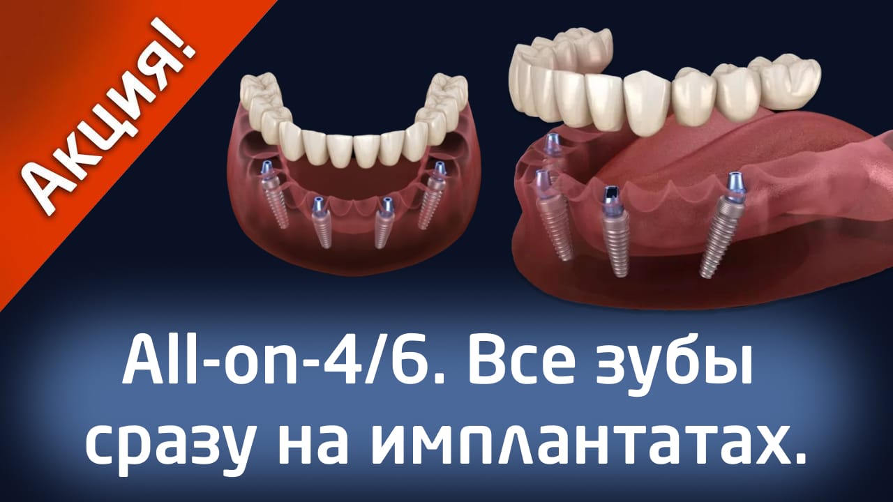 Акция All-on-4/6. Все зубы сразу на имплантатах