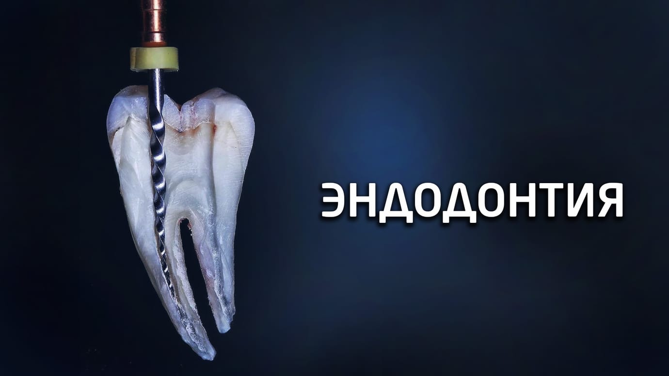 Лечение пульпита и периодонтита. Эндодонтия