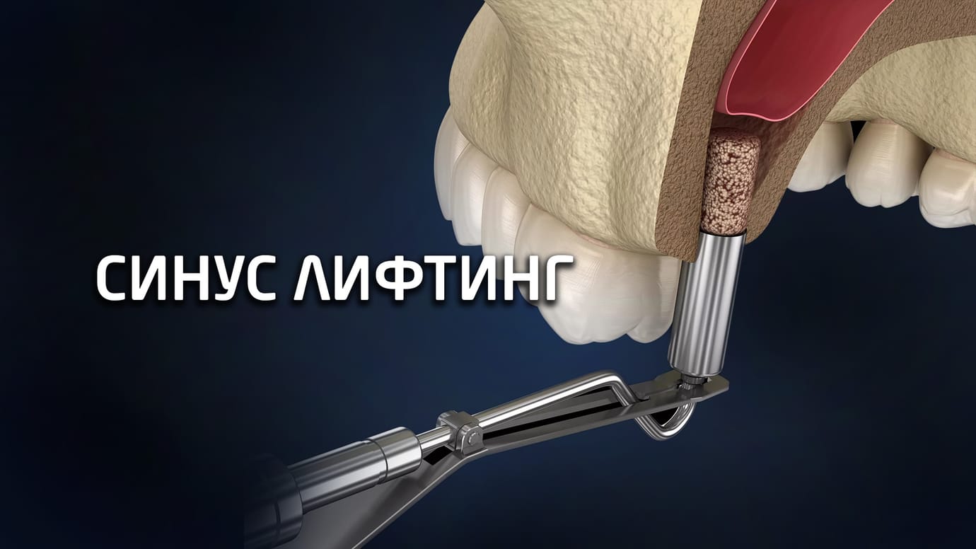 Синуслифтинг